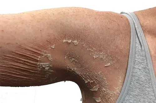 Granular-Parakeratosis-The-Rash-Everyone-Should-Be-Aware-Of| Skin Plus Compounding Pharmacy