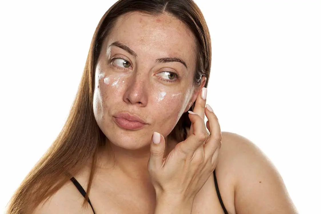 What-you-need-to-know-about-the-pigmentation-problem-called-melasma| Skin Plus Compounding Pharmacy