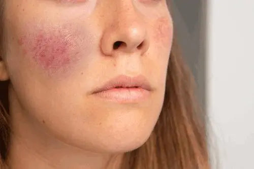 Topical-Oxymetazoline-for-Rosacea-Facial-Redness-and-Flushing-A-Comprehensive-Guide| Skin Plus Compounding Pharmacy