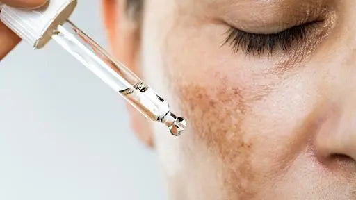 Hydroquinone for Melasma